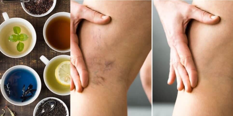 Tchau, varizes: Chá com 3 ingredientes populares acabam com manchas na perna das 60+ sem cirurgia
