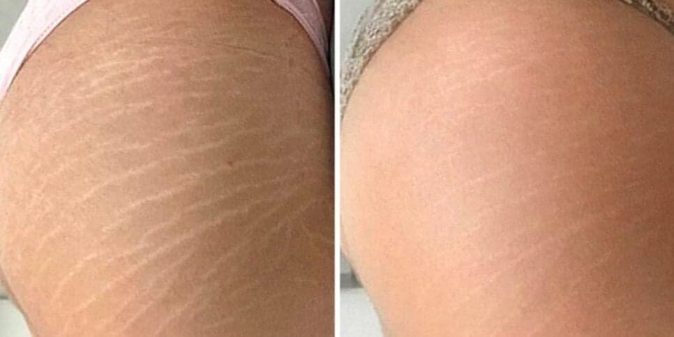 Tchau, estrias: Único ingrediente popular acaba com manchas das 50+ e traz melhor colágeno do mundo