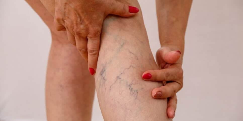 Adeus varizes na pele: Único ingrediente elimina problema e te deixa com as pernas dos sonhos