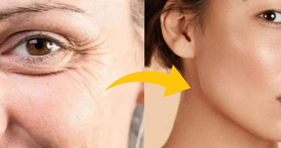 Botox caseiro: Misturinha com 3 ingredientes da cozinha dá fim nas rugas das 45+ em 25 minutos
