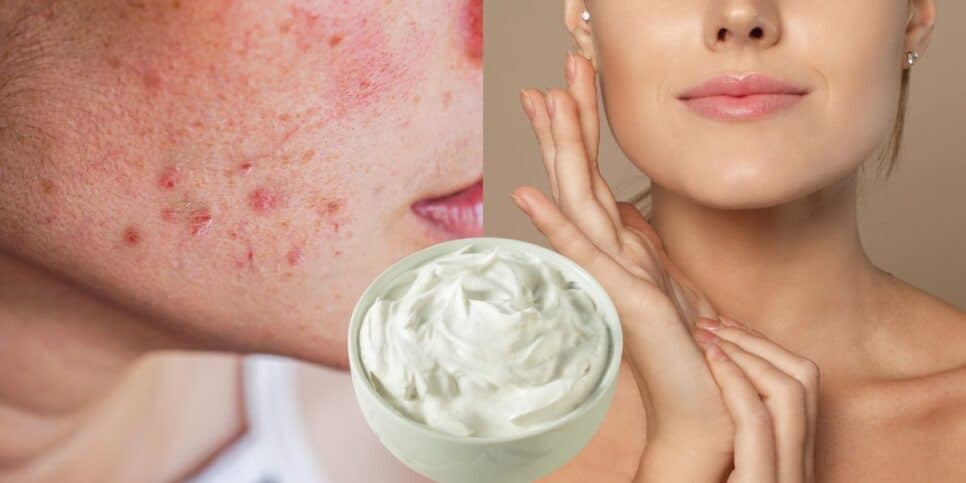 Fim das rugas e cravos: Botox caseiro com 2 ingredientes populares traz pele de porcelana