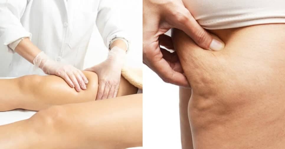 FIM da celulite: Receita com apenas 3 ingredientes deixa perna de mulheres 50+ com pele de bebê