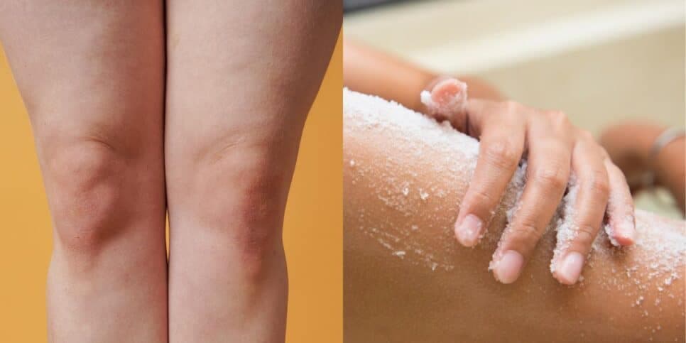 Fim das manchas: Esfoliante natural com 3 ingredientes traz hidratação potente para clarear joelhos de idosas 60+