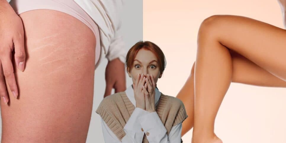 Adeus estrias: 3 ingredientes garantem a pele lisa igual de bebê em 6 passos infalíveis