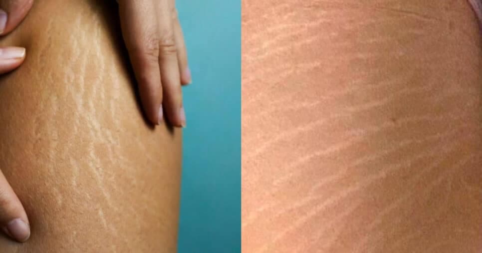 Economize mais de R$ 1.800 em tratamento: Óleo natural acaba com estrias em 10 minutos