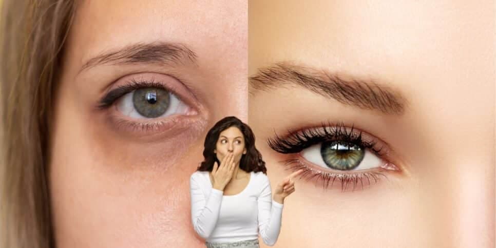 Fim das olheiras: 1 único ingrediente extermina as manchas dos olhos das em 15 minutos