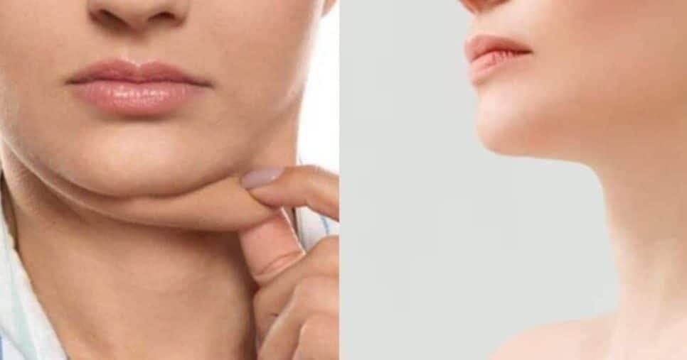 Método caseiro acaba com a papada sem precisar de botox