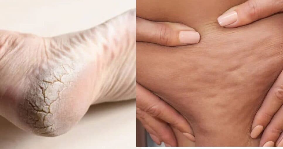 ADEUS pés rachados e celulite: 2 receitas caseiras pra acabar terror das mulheres 45+ sem gastar 1 real