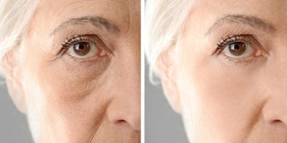 Colágeno milagroso e potente rejuvenesce idosas 60+ com fim das rugas em 15 minutos