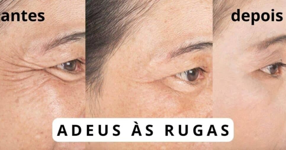 Melhor que plástica: Receitinha com 4 ingredientes extermina às rugas e manchas das 50+
