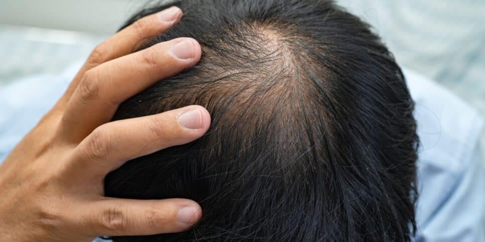 Calvície - Queda de cabelo (Foto: Reprodução) 
