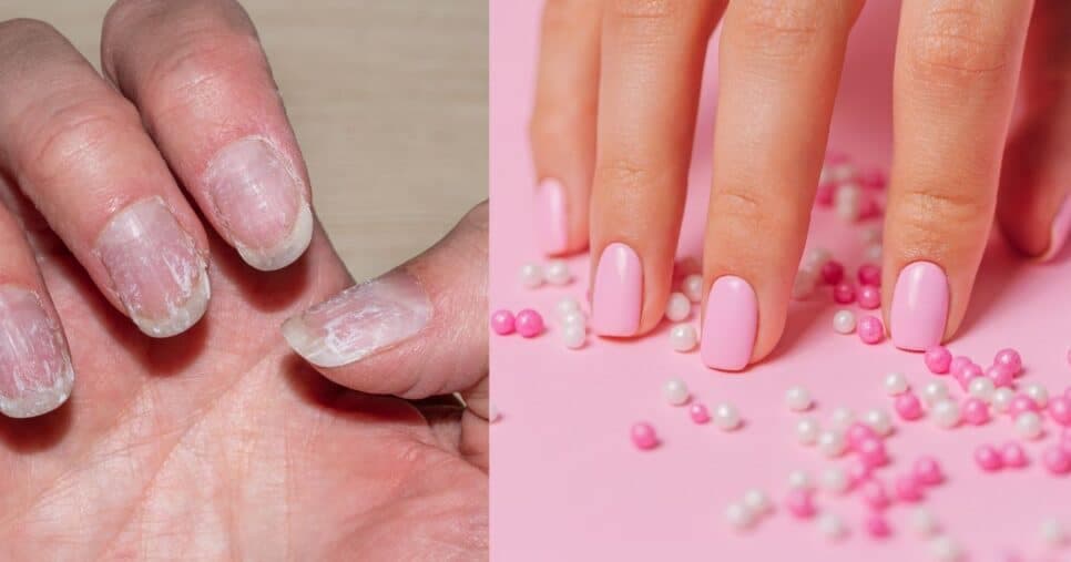 Tchau, quebra e enfraquecimento: 5 truques infalíveis para recuperar as unhas após extensões em gel
