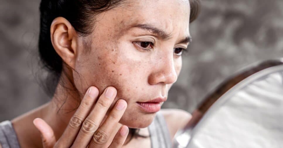 Estão proibidas: 7 atitudes comuns que pioram o melasma das 60+ e devem ser banidas IMEDIATAMENTE