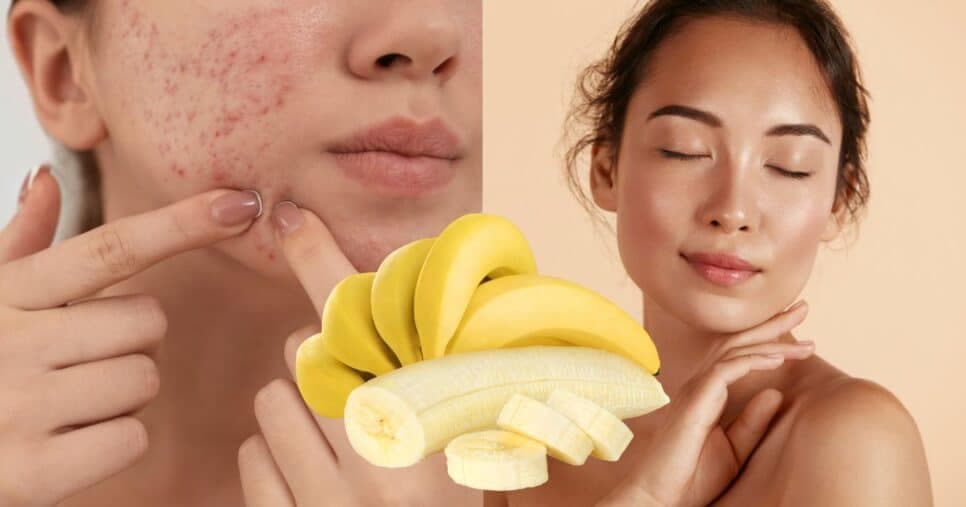 Pele lisinha eternamente: Limpeza facial caseira com banana remove cravos e espinhas sem dor