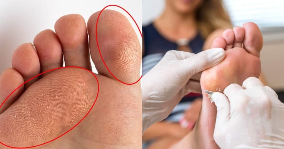 Podólogas escondem: Em apenas 5 passos simples é possível dar adeus aos calos dos pés para sempre