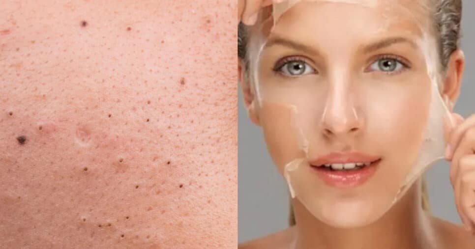 Tchau, cravos e espinhas: Peeling caseiro elimina tormento e dá pele de porcelana às 40+
