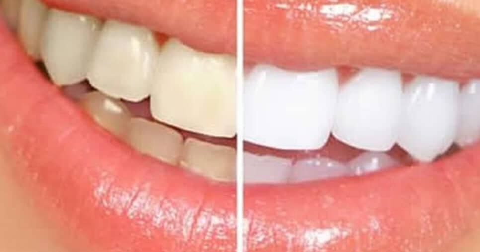 Nem dentista faz: 5 dicas que deixam dentes brancos e reduzem manchas mesmo para quem toma muito café