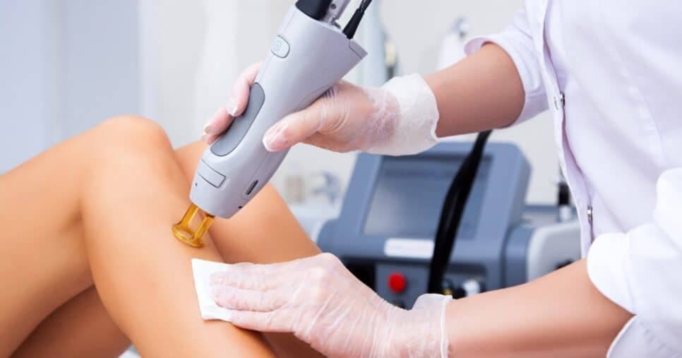 Efeito de depilação a laser: Mistura natural com 2 ingredientes tira pelos e traz pele lisinha