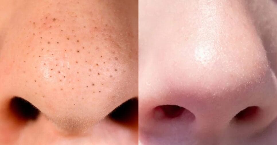 Limpeza de pele sem gastar 1 real: Receitinha caseira com 2 ingredientes dá fim aos cravos do nariz