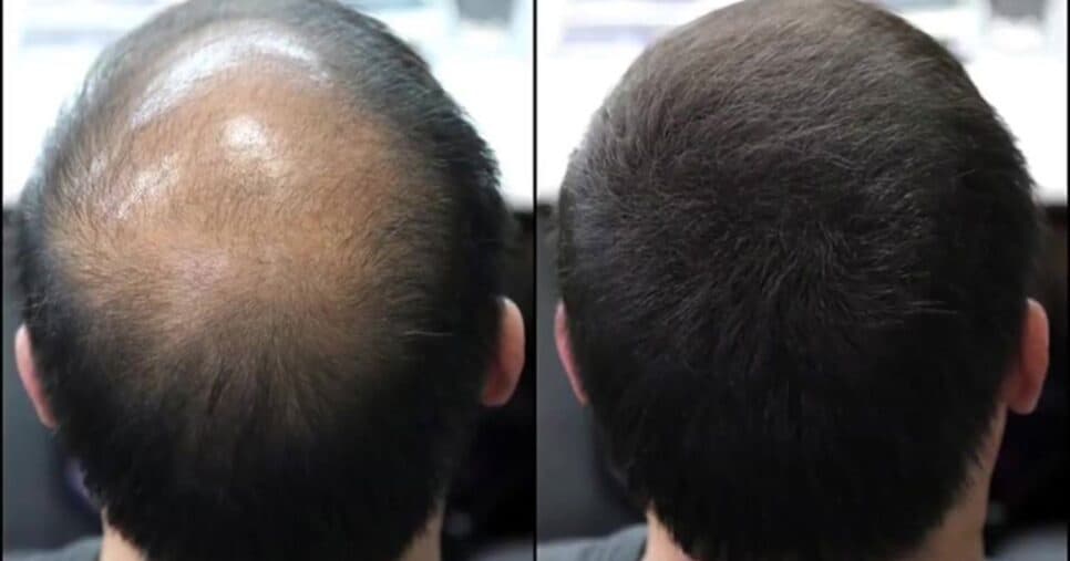 Fim da calvície: Receita caseira poderosa com 1 ingrediente recupera o cabelo de homens 50+ em 2 semanas