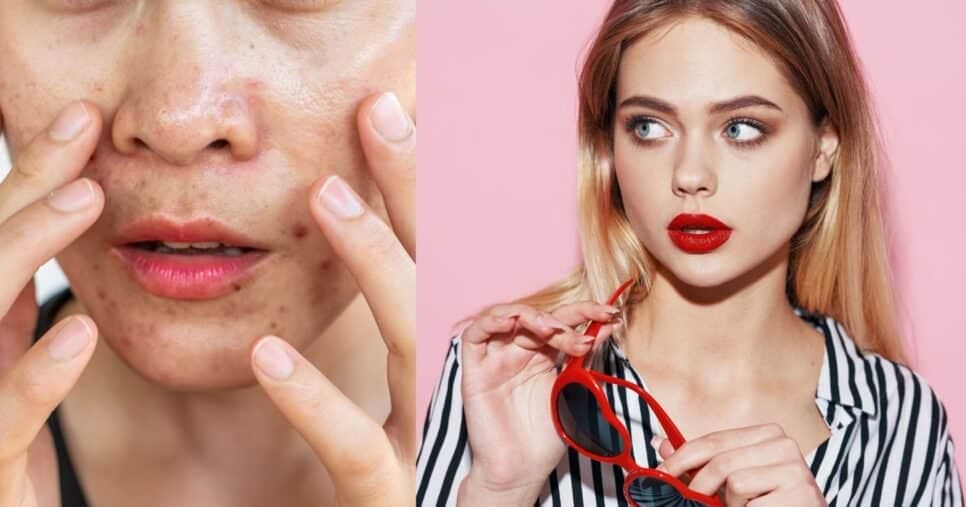 Pele sequinha o dia todo: 5 passos infalíveis controlam a oleosidade e livrem mulheres 20+ da acne no verão