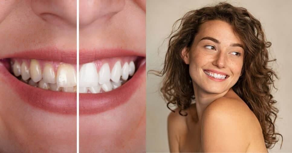 Sorriso branco como a neve: Receita caseira com 4 ingredientes para clarear os dentes sem sair de casa