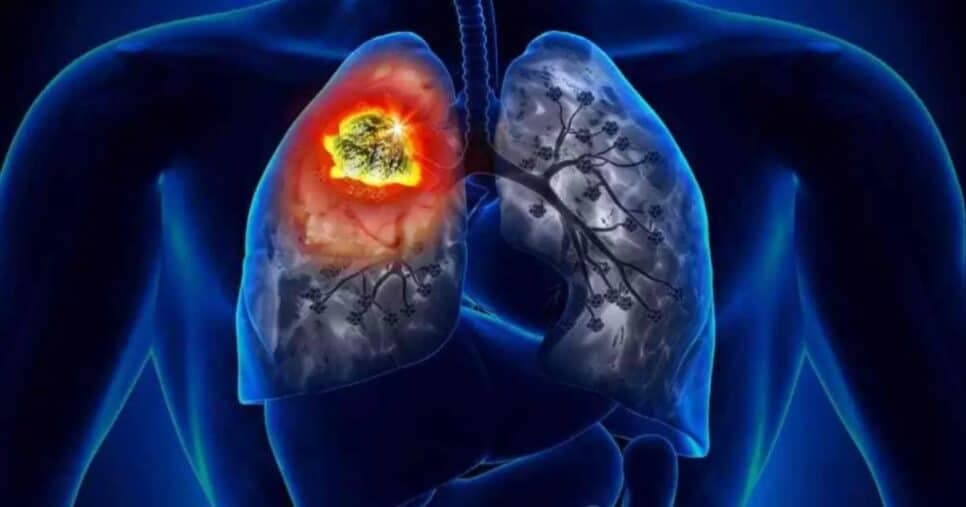 Não é só cigarro: 3 causas além de fumar que trazem o diagnóstico de câncer de pulmão e podem MATAR