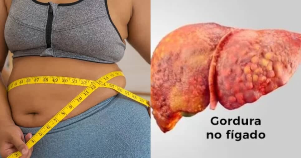 Fadiga, fraqueza e perda de apetite: 7 sinais silenciosos que indicam gordura disparada no fígado dos 60+