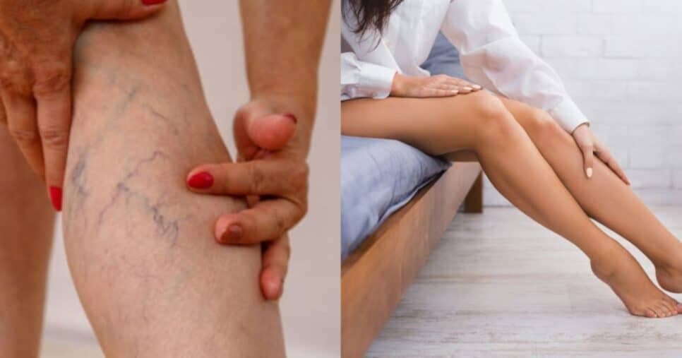 Pernas leves e lisinhas: Mistura natural com 4 ingredientes elimina varizes para o verão 2025