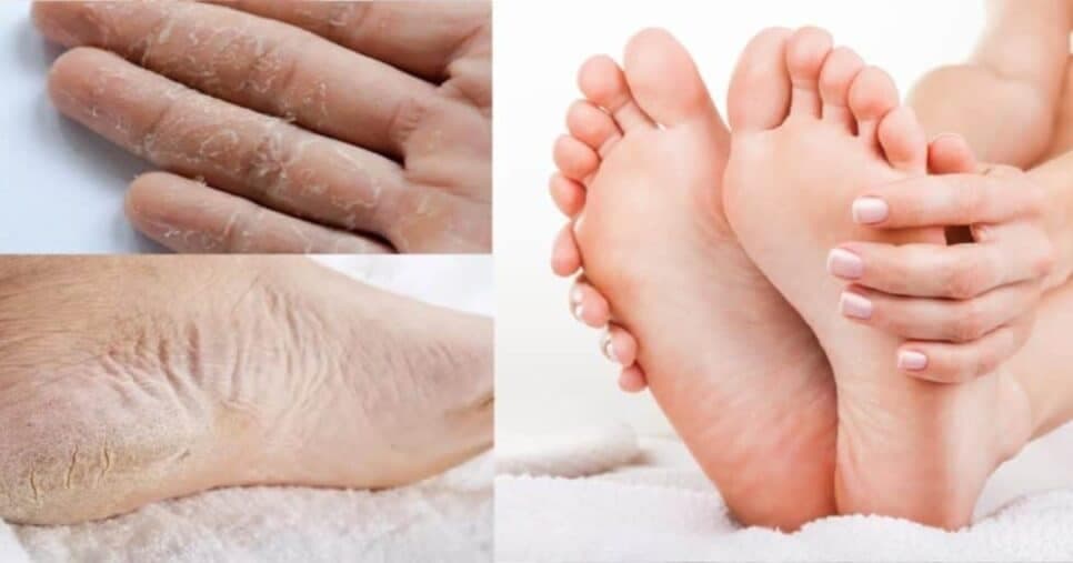 Fim dos pés e mãos rachados: Mistura com 3 ingredientes traz pele de bebê as idosas 60+