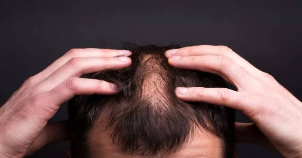 Fim da calvície: 2 remédios naturais acabam com a queda de cabelo dos homens 45+ instantaneamente