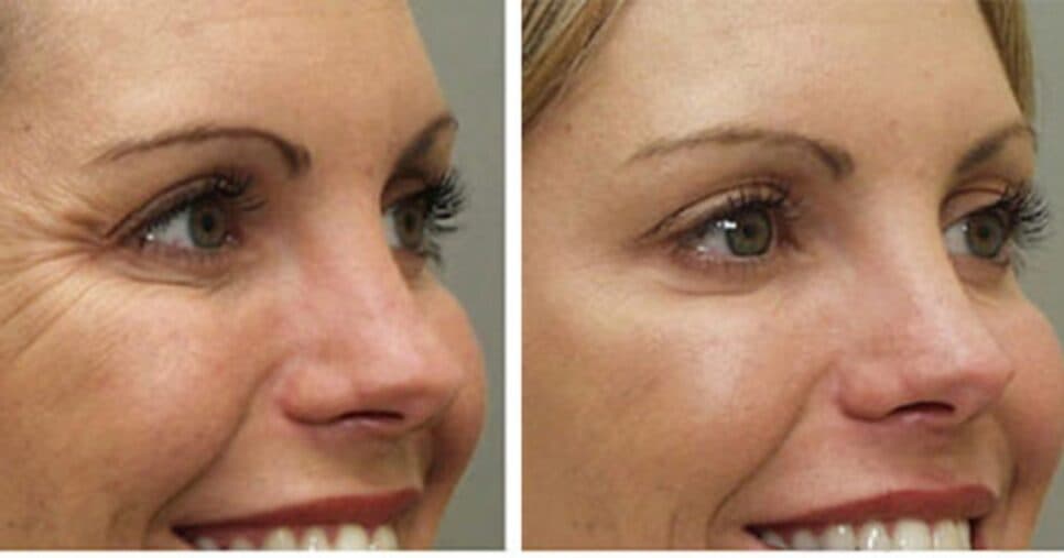 Rugas aniquiladas: Colágeno caseiro com 2 ingredientes traz creme facial potente para rejuvenescer em 2025