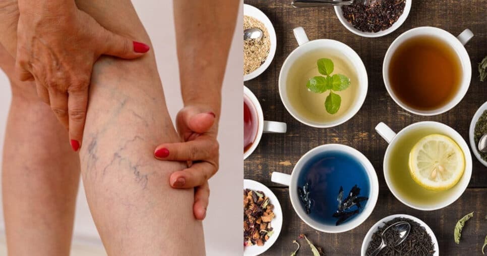 Adeus varizes: Chá milagroso com 2 ingredientes elimina tormento das 50+