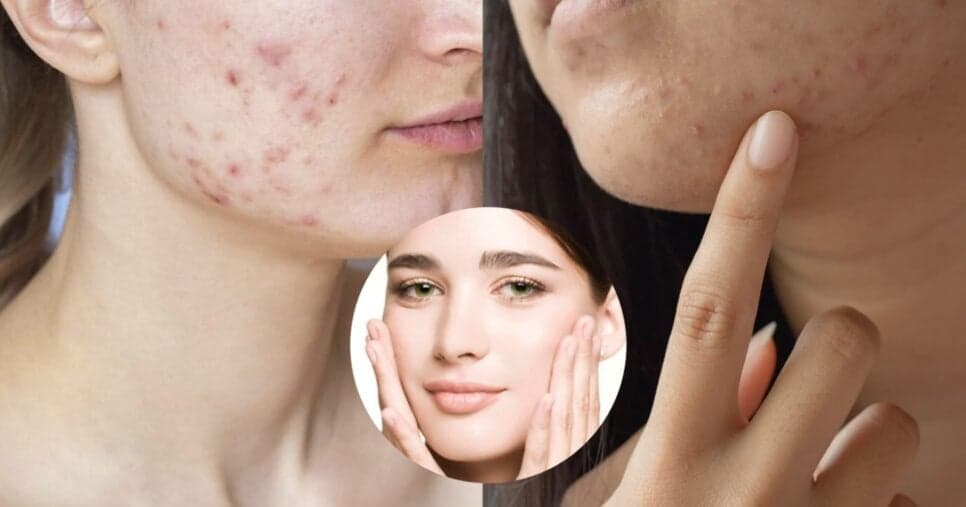 Fim das espinhas e manchas no rosto: 4 dicas infalíveis para ter a pele perfeita como porcelana