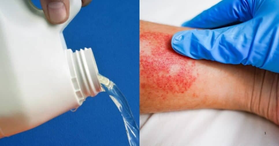 Água Sanitária sem registro pode causar queimaduras na pele (Foto Reprodução/Montagem/Tv Foco/Canva/Lennita)