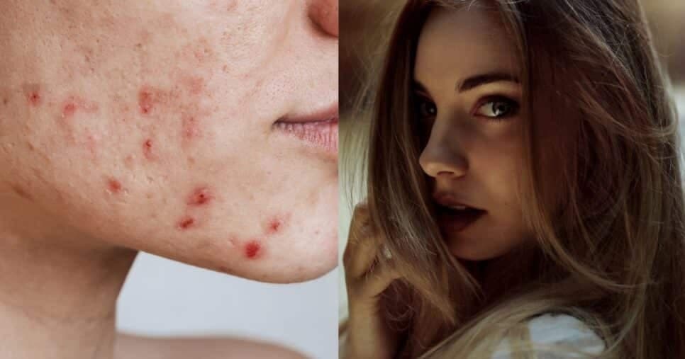 Adeus, brilho e espinhas: 5 passos acabam com a oleosidade e transformam pele de mulheres 25+