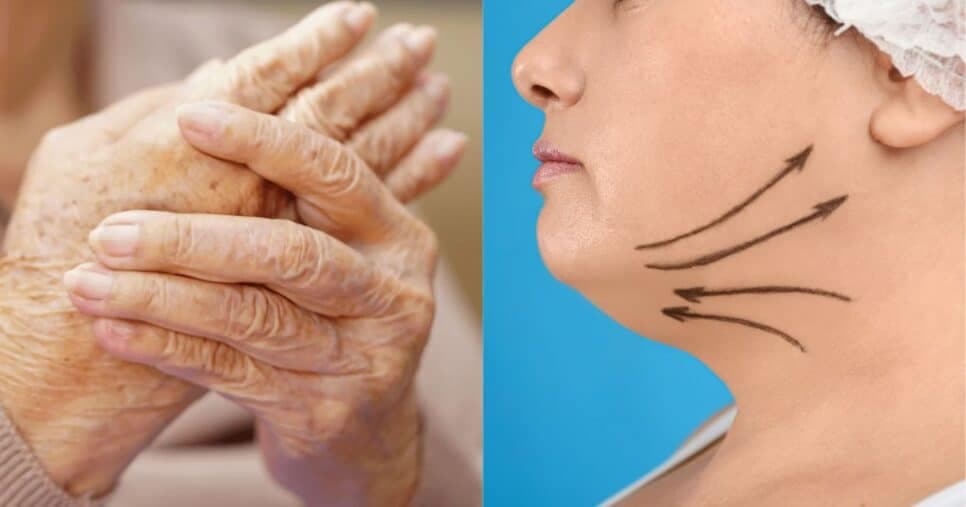 Creme natural com 3 ingredientes +3 passos acabam com rugas nas mãos e papada instantaneamente