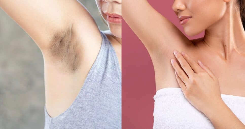 Adeus, depilação a laser: Mistura com 4 ingredientes remove manchas e deixa axilas lisinhas em 5 minutos