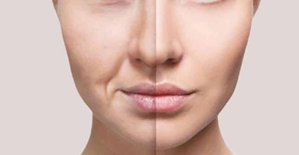 Adeus, bigode chinês e rugas: Creme caseiro com 4 ingredientes infalíveis te dá pele de porcelana