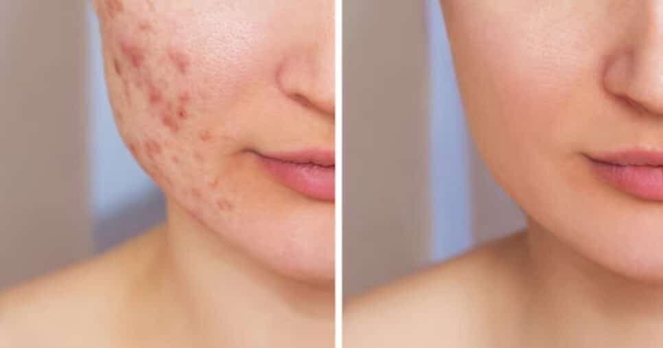Fim do laser: 4 ingredientes acabam com qualquer cicatriz da pele em menos de 1 minuto