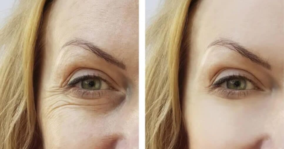 Harmonização facial de graça: Mistura com 2 ingredientes extermina rugas antes do Carnaval