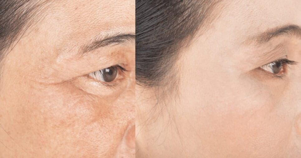 Pele firme, jovem e radiante: Remova rugas do rosto e paralise o envelhecimento usando 4 ingredientes