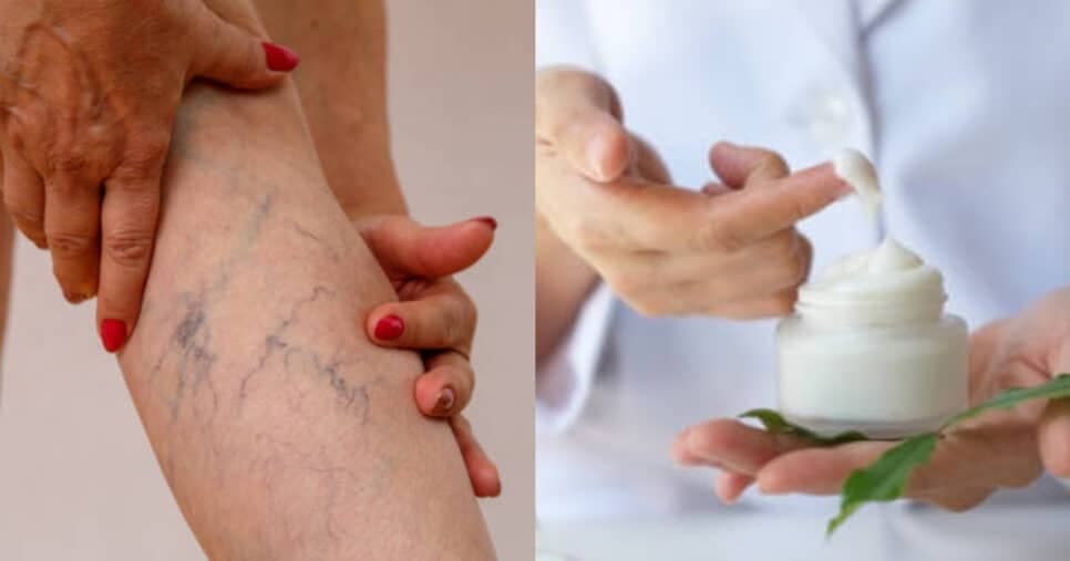 Fim das varizes: Creme natural com 2 ingredientes reduz o surto nas veias e traz pele de bebê às 60+