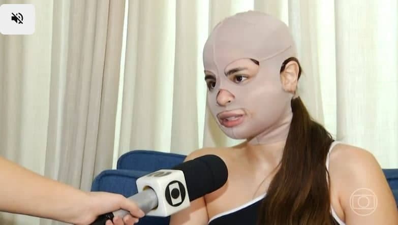 Depoimento de Isadora, a qual sofreu queimaduras após aplicação (Foto Reprodução/Globo)