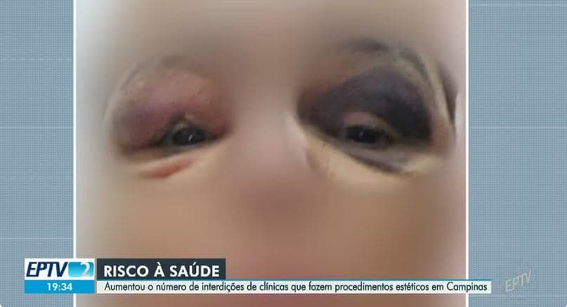 Hematomas e inchaço na vítima causado pelo procedimento estético em uma clínica de Campinas (Foto Reprodução/EPTV/Globo)