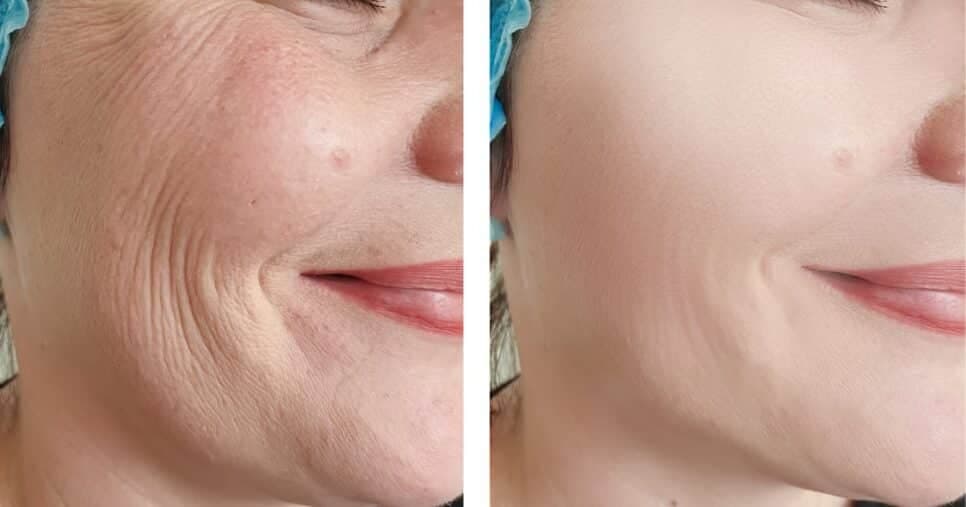 Fim do rosto seco, com rugas e lábios rachados: 2 receitas hidratam e rejuvenescem a pele no Outono