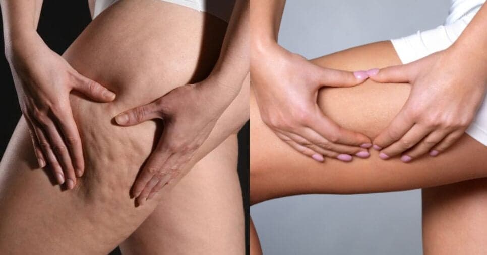 Bumbum e pernas lisinhas aos 45+: Único ingrediente caseiro elimina celulite e rejuvenesce em 10 minutos