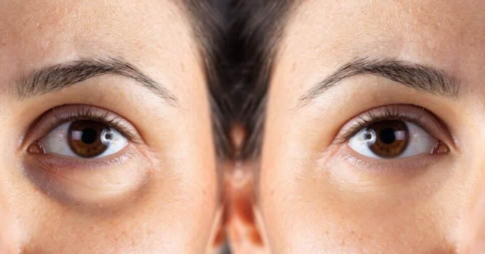 Dermatologistas escondem: 2 ingredientes populares clareiam olheiras e revivem o olhar em 5 minutos