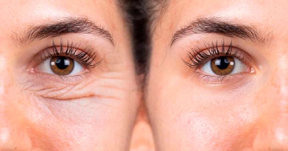 Pare de gastar fortuna em cremes: 1 ingrediente comum apaga rugas e pés de galinha em poucas noites