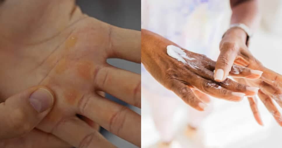 Rejuvenescem 30 anos: Mistura com 4 ingredientes acaba com o ressecamento e calos das mãos